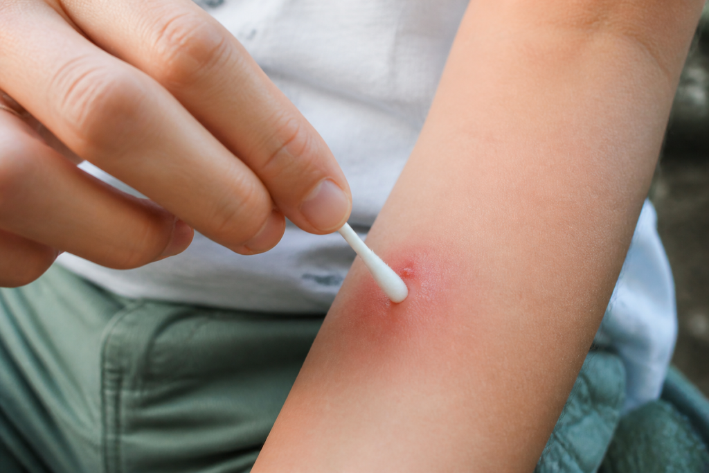 Main appliquant antiseptique sur piqure rouge enflammee