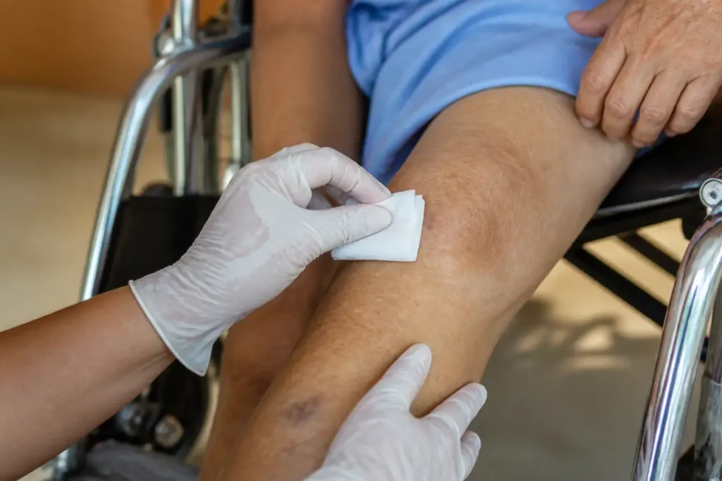 Mains gantees nettoient jambe avec compresse sterile